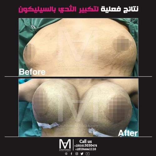 كيف تتم عملية تجميل الثدي؟